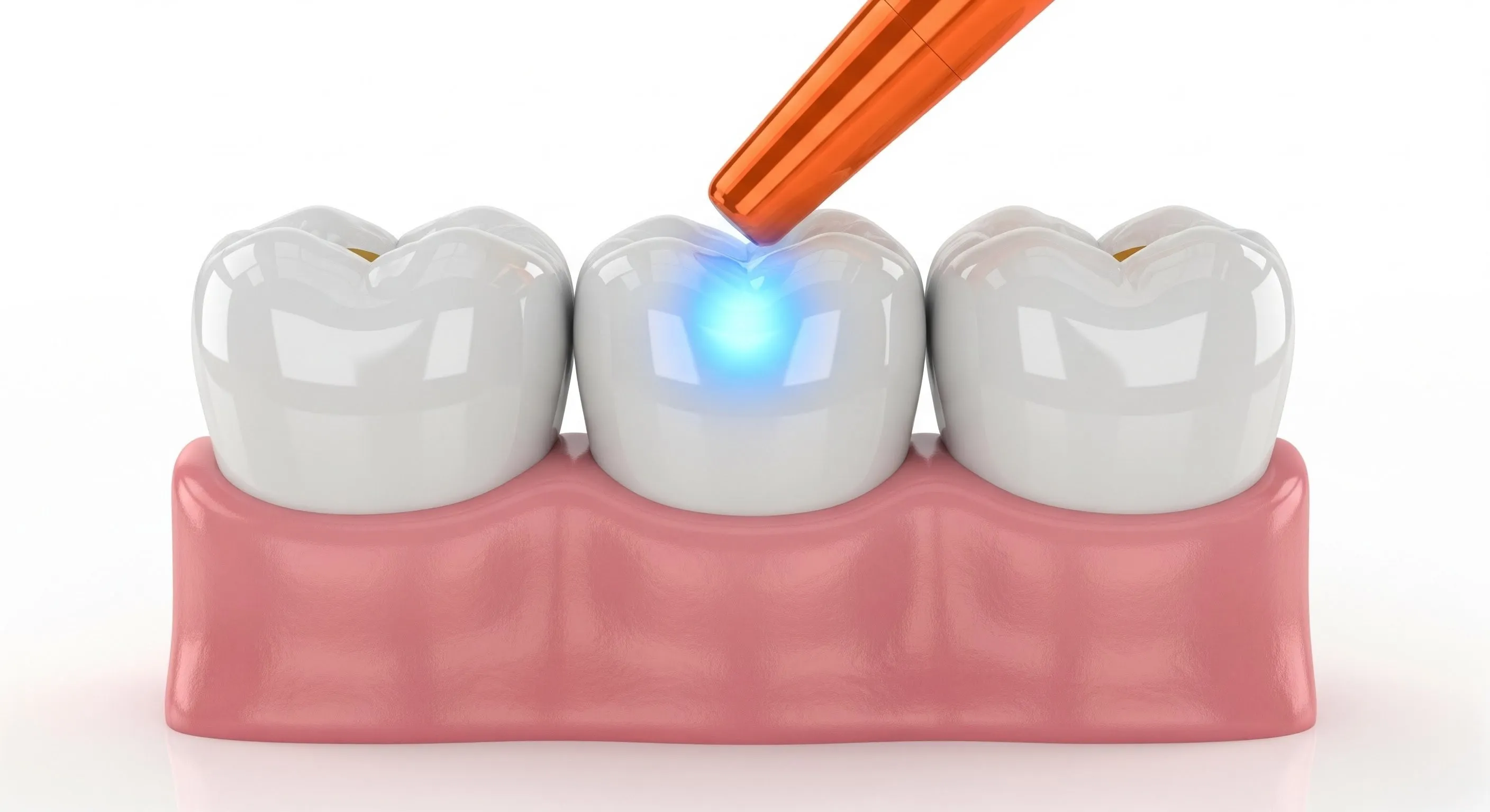 Composite Fillings Cost and Pricing Information in Centennial