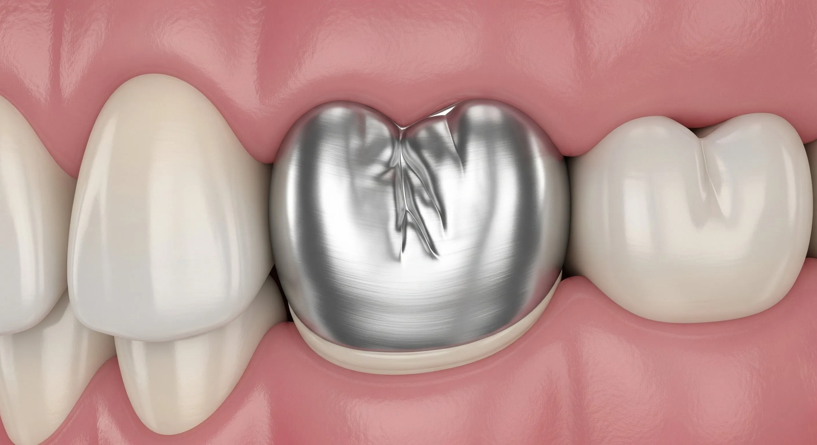 Silver vs. Composite Fillings