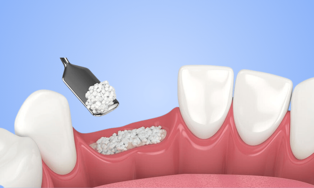 Why Choose Bone Grafting in Centennial?