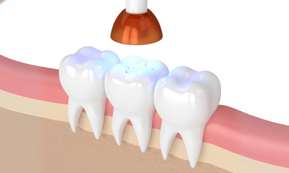 Composite Fillings Cost and Pricing Information in Centennial